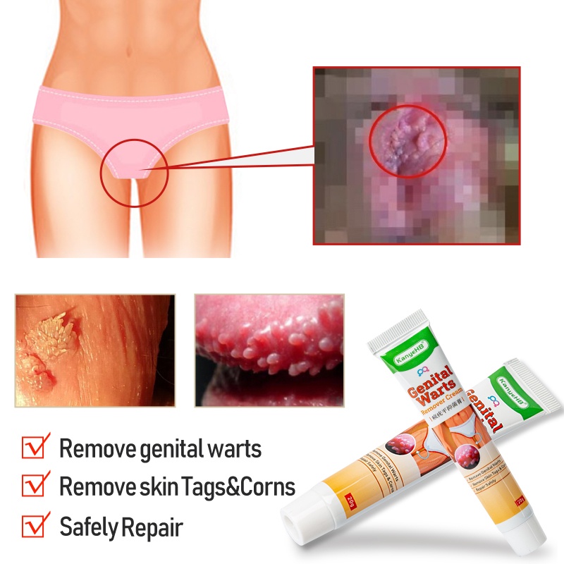 Jual Wart Remover Ointment Genital Herpes Genital Vulva Condyloma