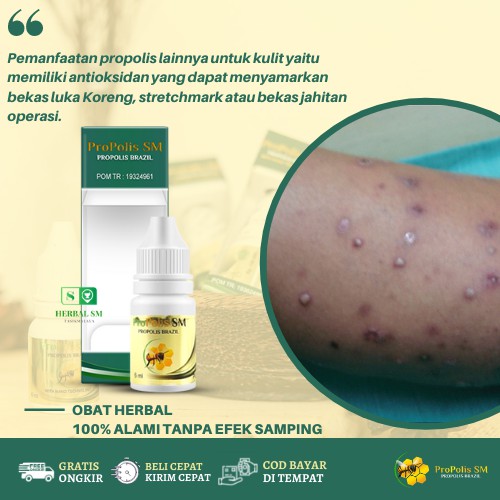 Jual Obat Penghilang Bekas Koreng Di Kaki Hitam Menghitam Luka