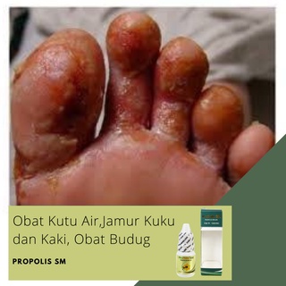 Jual Obat Kutu Air Pada Kaki Jamur Di Kuku Kutu Air Sela Jari