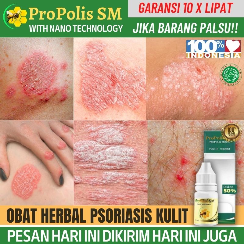 Jual Obat Gatal Selangkangan Wanita 100 Alami Mengatasi Jamur Kurap