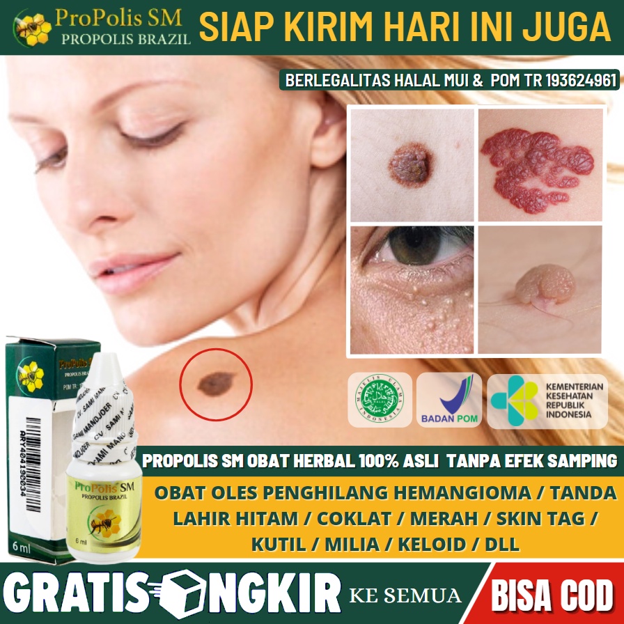 Jual Obat Tahi Lalat Aman Alami Obat Tahi Lalat Di Wajah Leher