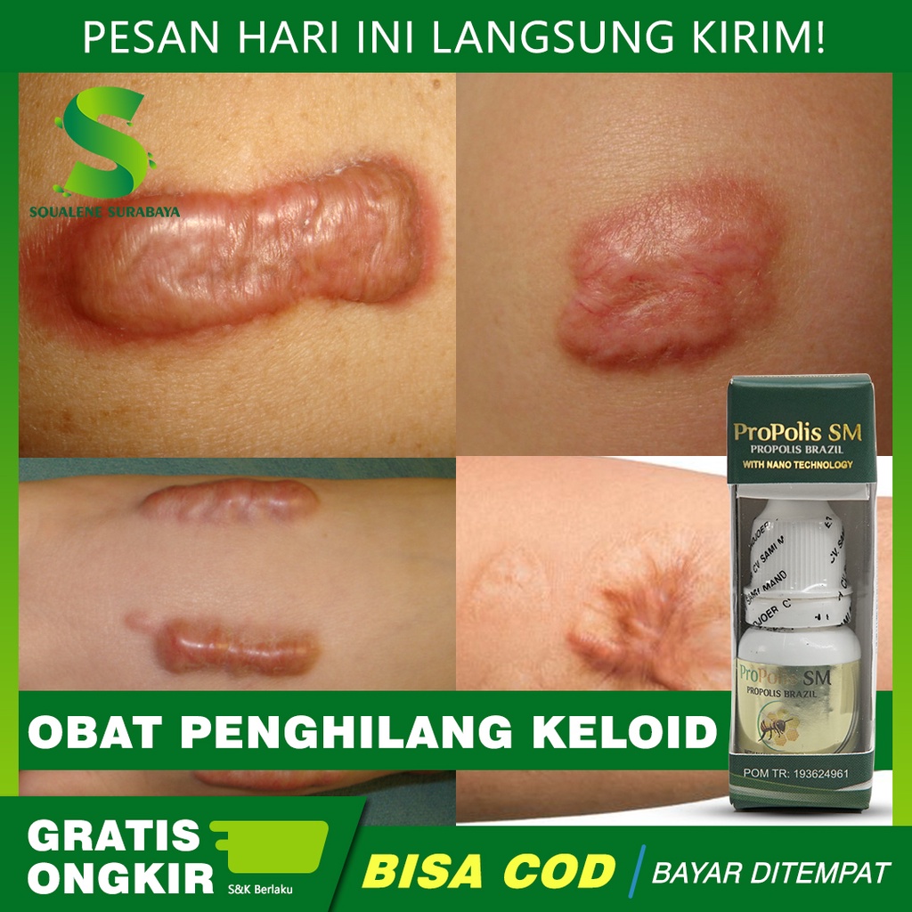 Jual Obat Penghilang Keloid Pengempes Benjolan Limpoma Penghilang