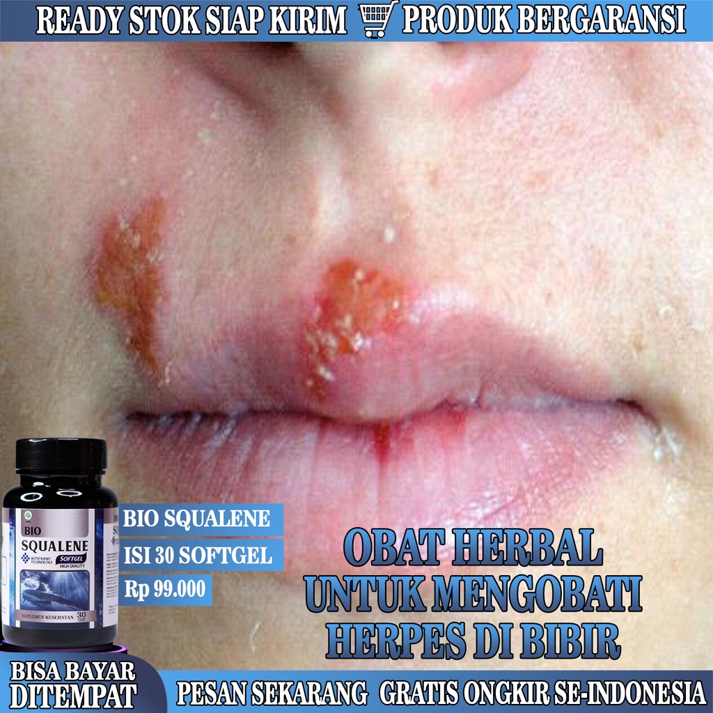 Jual Obat Herpes Genital Di Bibir Obat Herpes Bibir Obat Luka Melepuh