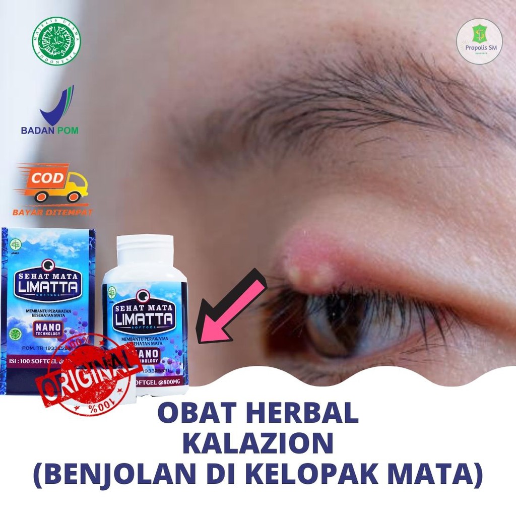 Jual Obat Mata Kalazion Benjolan Di Kelopak Mata Sehat Mata Limatta