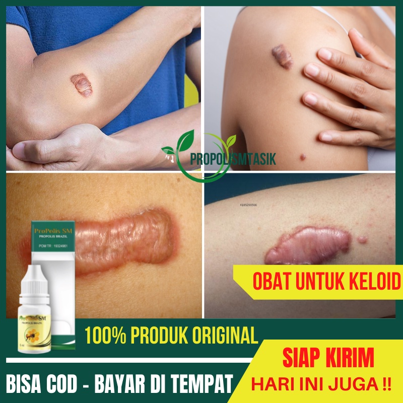 Jual Obat Keloid Menahun Daging Tumbuh Di Kulit Bekas Operasi Sesar