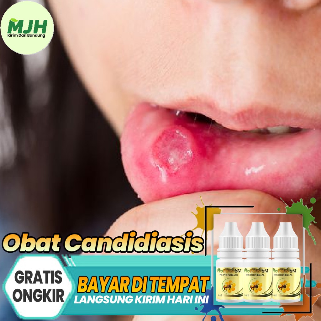 Jual Propolis Sm Obat Candidiasis Mengobati Infeksi Jamur Candida Kulit