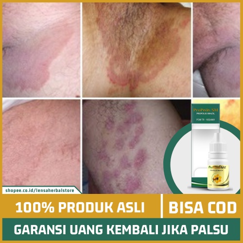 Jual Obat Infeksi Jamur Dermatofita Atau Tinea Cruris Gatal Pada