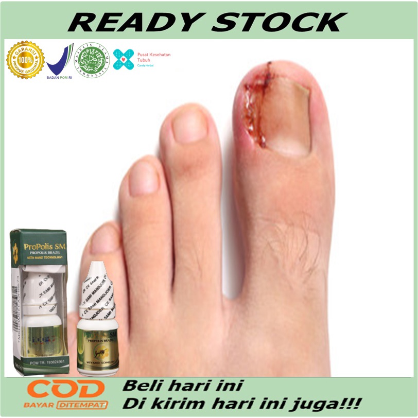 Jual Obat Cantengan Jempol Kaki Bengkak Obat Herbal Cantengan Obat