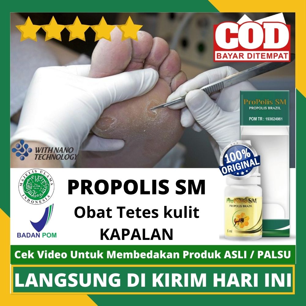 Jual Obat Kapalan Obat Tetes Penghilang Kapalan Di Kaki Dan Tangan