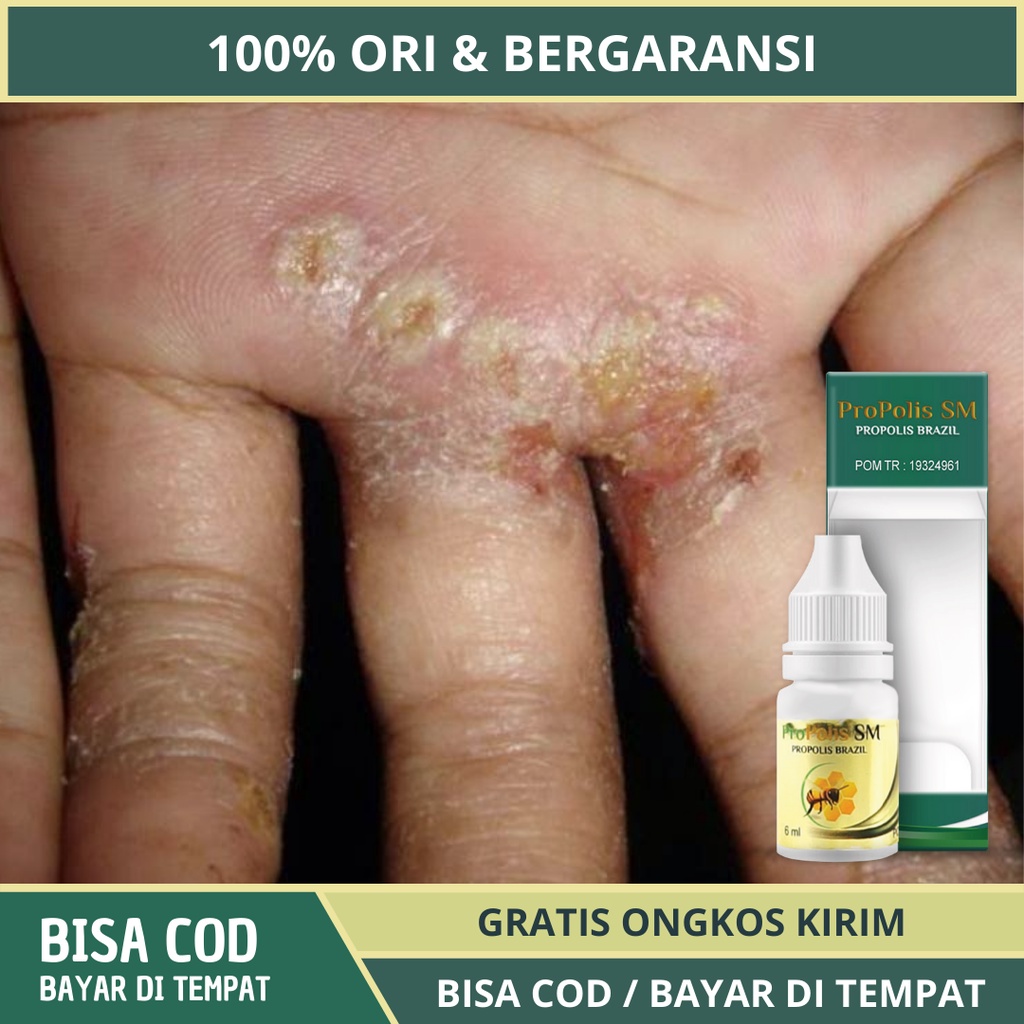 Jual Obat Budug Bpom Obat Budug Di Kaki Obat Budug Santri Obat Budug