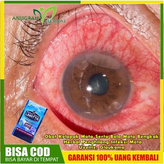 Jual Obat Kelopak Mata Serta Bola Mata Bengkak Herbal Penghilang