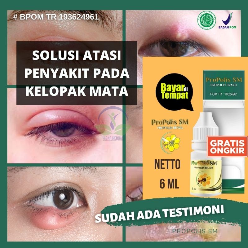 Jual OBAT PENGEMPIS BENJOLAN DI KELOPAK MATA PENGHILANG BENJOLAN DI