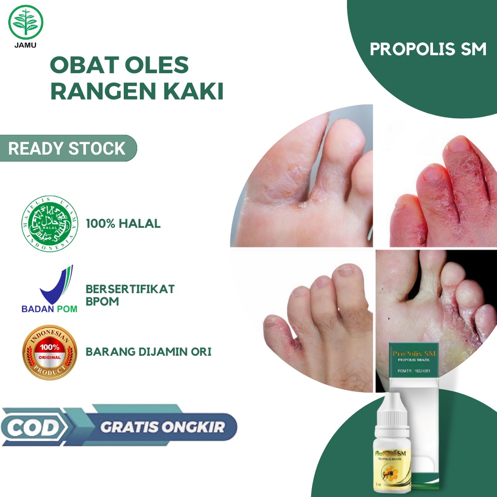 Jual Obat Rangen Kaki Obat Gatal Gatal Kaki Kutu Air Di Kaki Obat