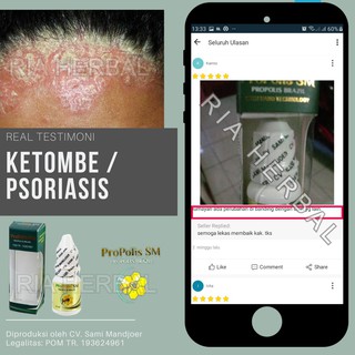 Jual OBAT TETES UNTUK BOROK DI KULIT KEPALA JAMUR PSORIASIS BERSISIK