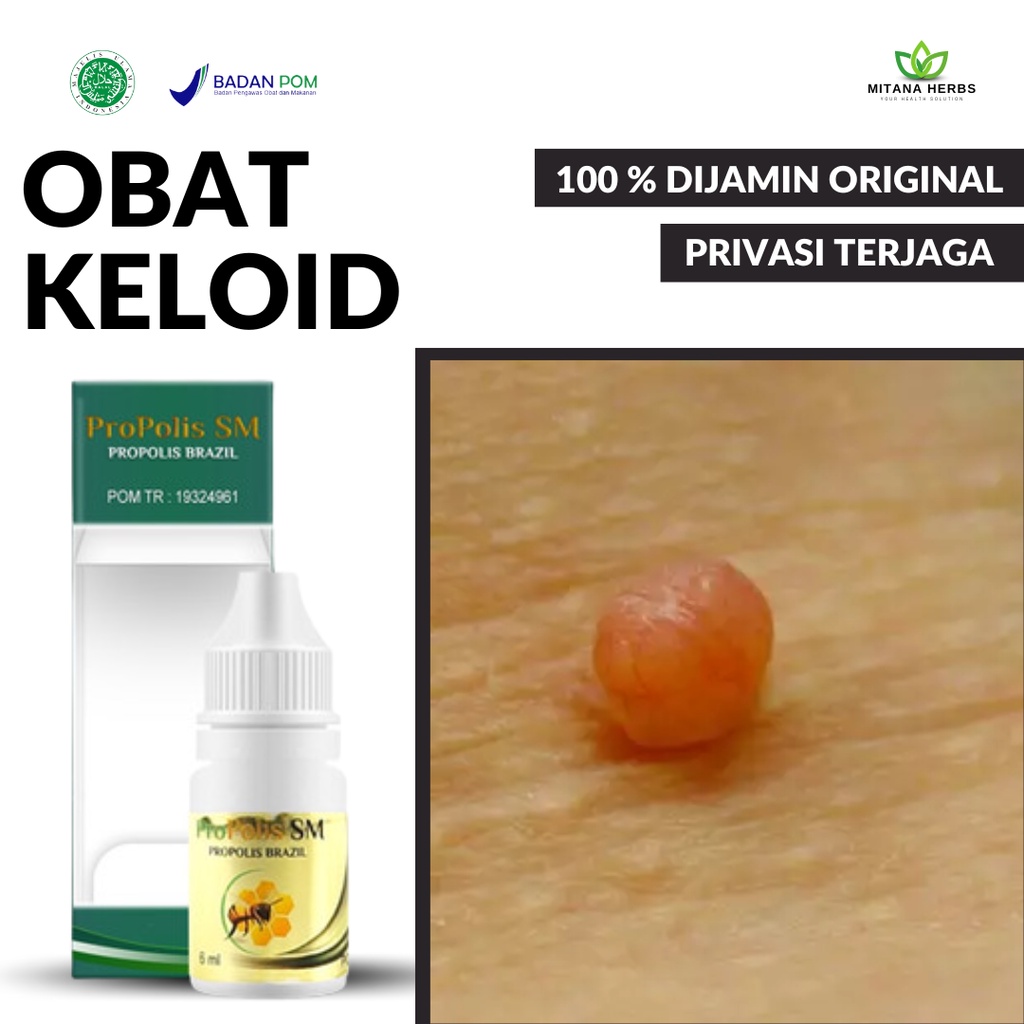 Jual Mitana Herbal Obat Penghilang Daging Tumbuh Obat Keloid Daging