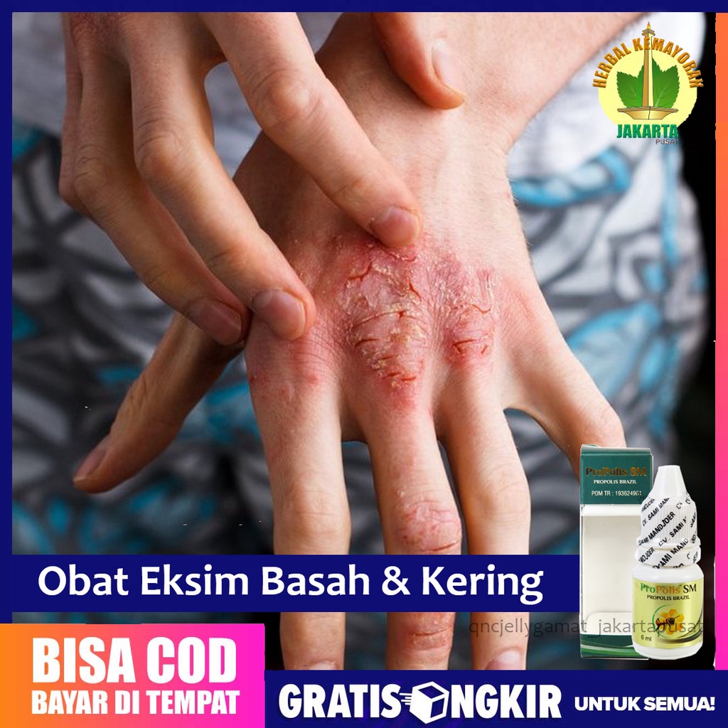 Jual Obat Eksim Basah Dan Kering Gudikan Infeksi Jamur Kulit Ruam