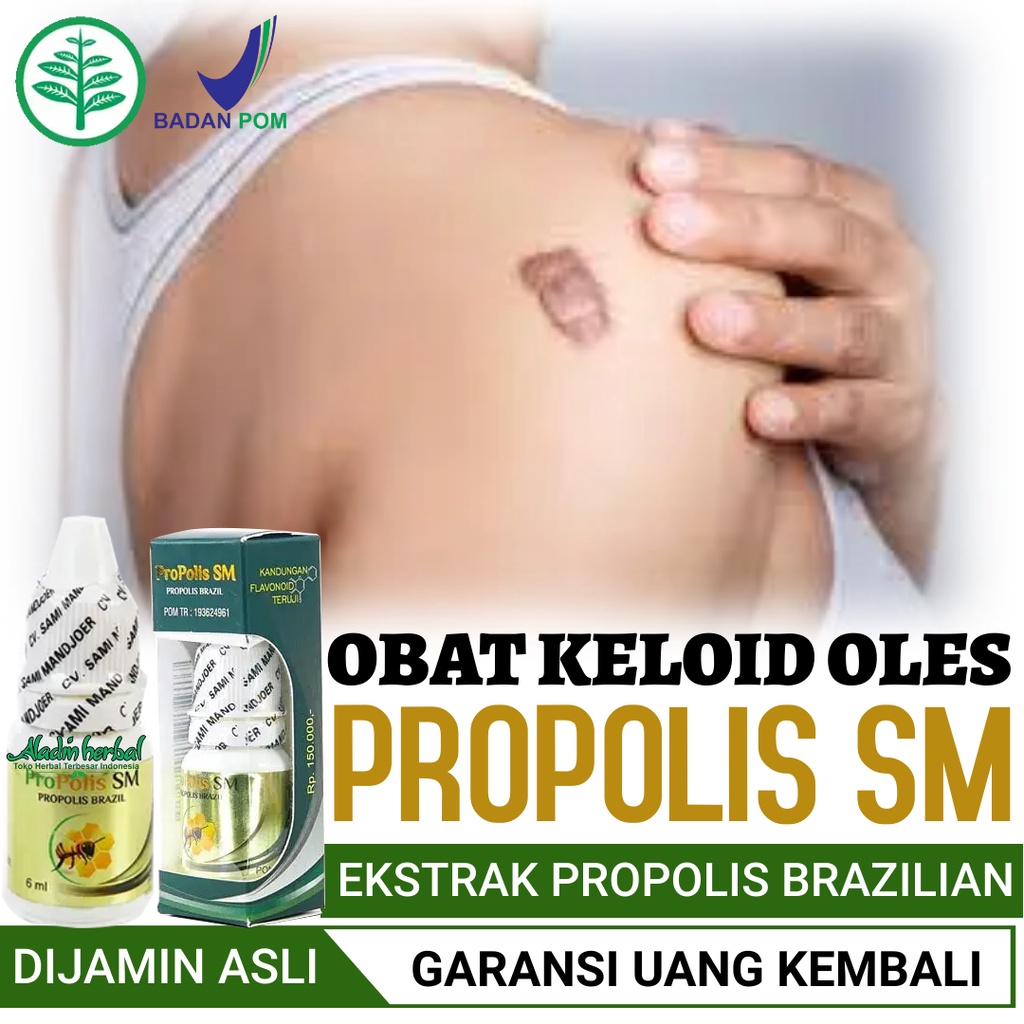 Jual Obat Penghilang Keloid Alami Obat Keloid Daging Tumbuh