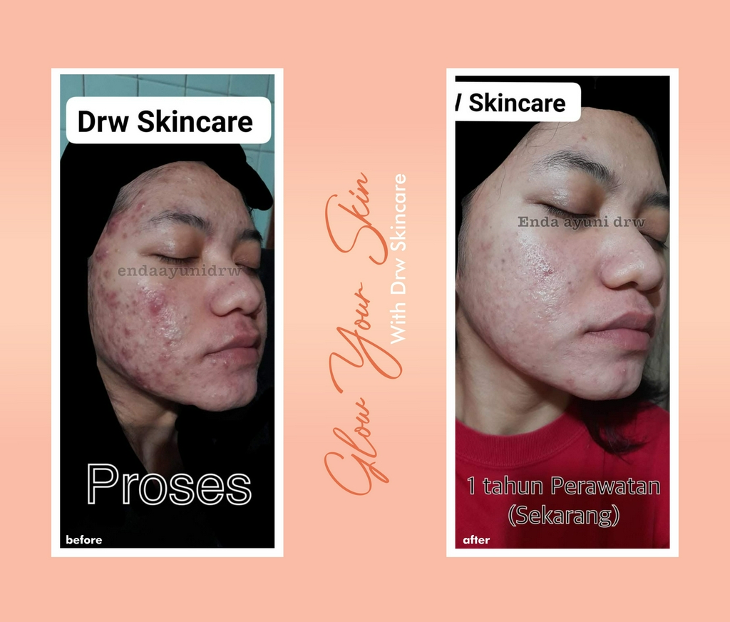 Produk Dokter Wahyu Drw Skincare Shopee Indonesia