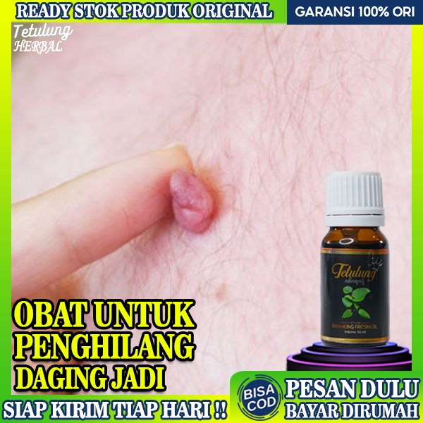 Jual Obat Pengempis Daging Jadi Paling Ampuh Perontok Papiloma