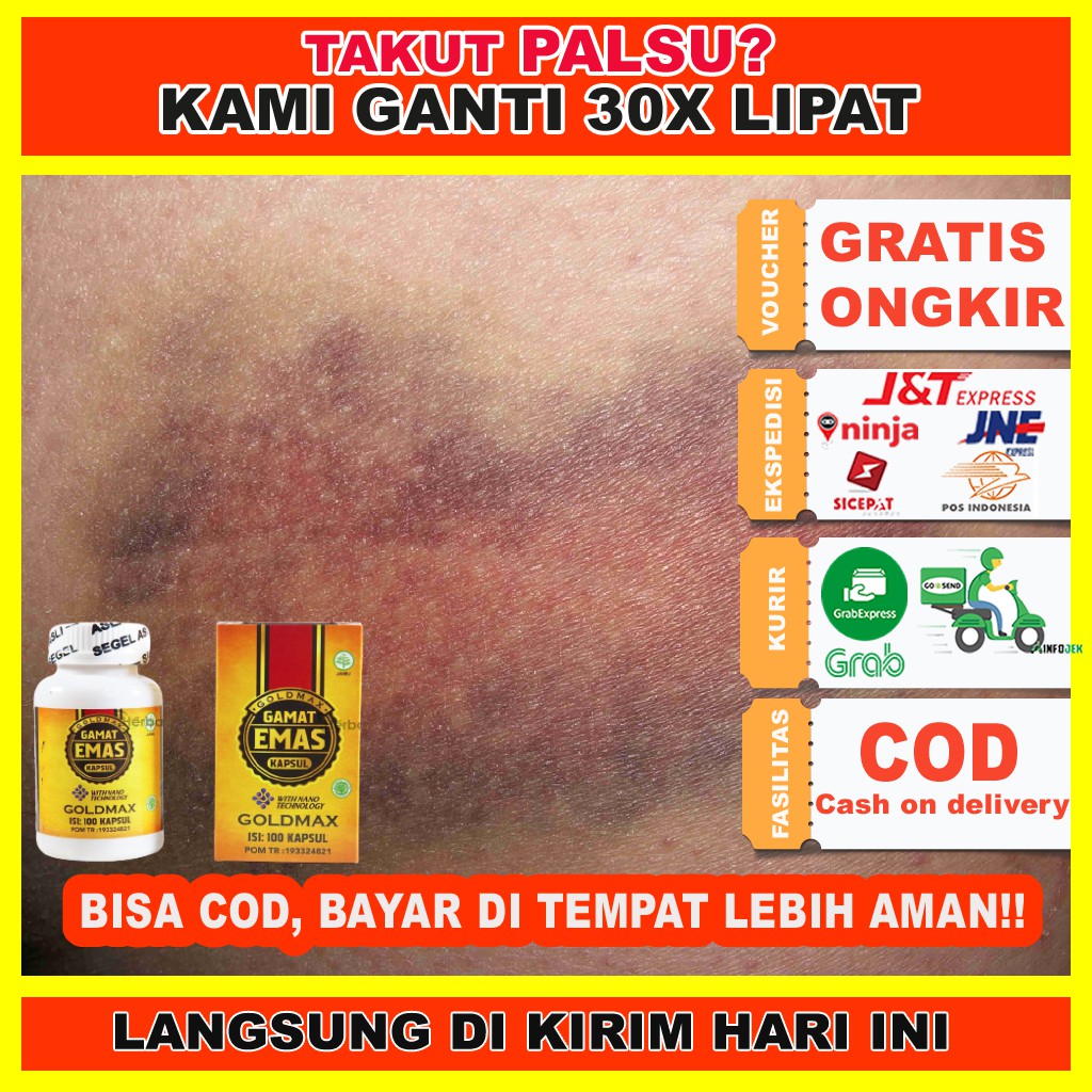 Jual Obat Luka Memar Obat Luka Dalam Memar Obat Luka Lebam Gamat