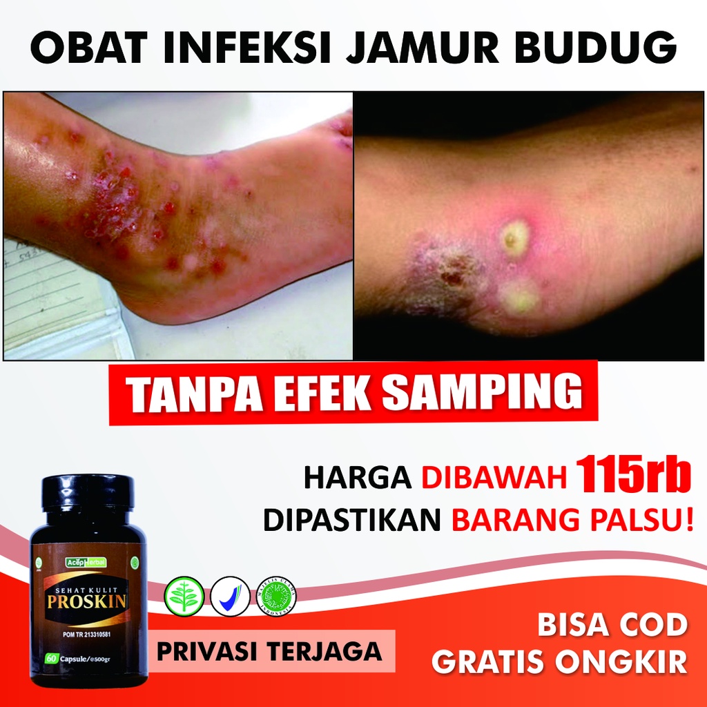 Jual Obat Infeksi Jamur Budug Gatal Cenang Koreng Bernanah Alergi Cacar