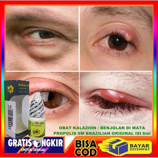 Jual Obat Mata Kalazion Benjolan Di Kelopak Mata Mata Bengkak