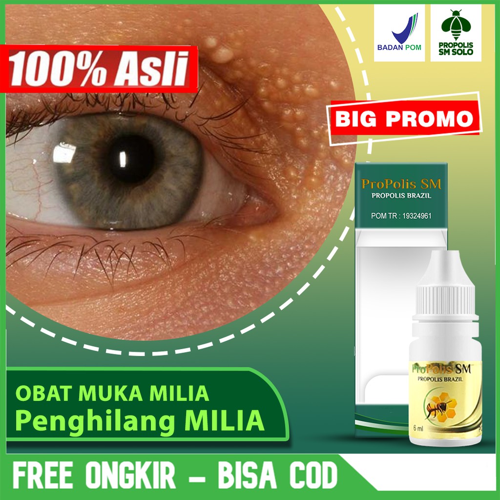 Obat Muka Milia Milea Penghilang Milia Di Wajah Propolis Sm Brazilian