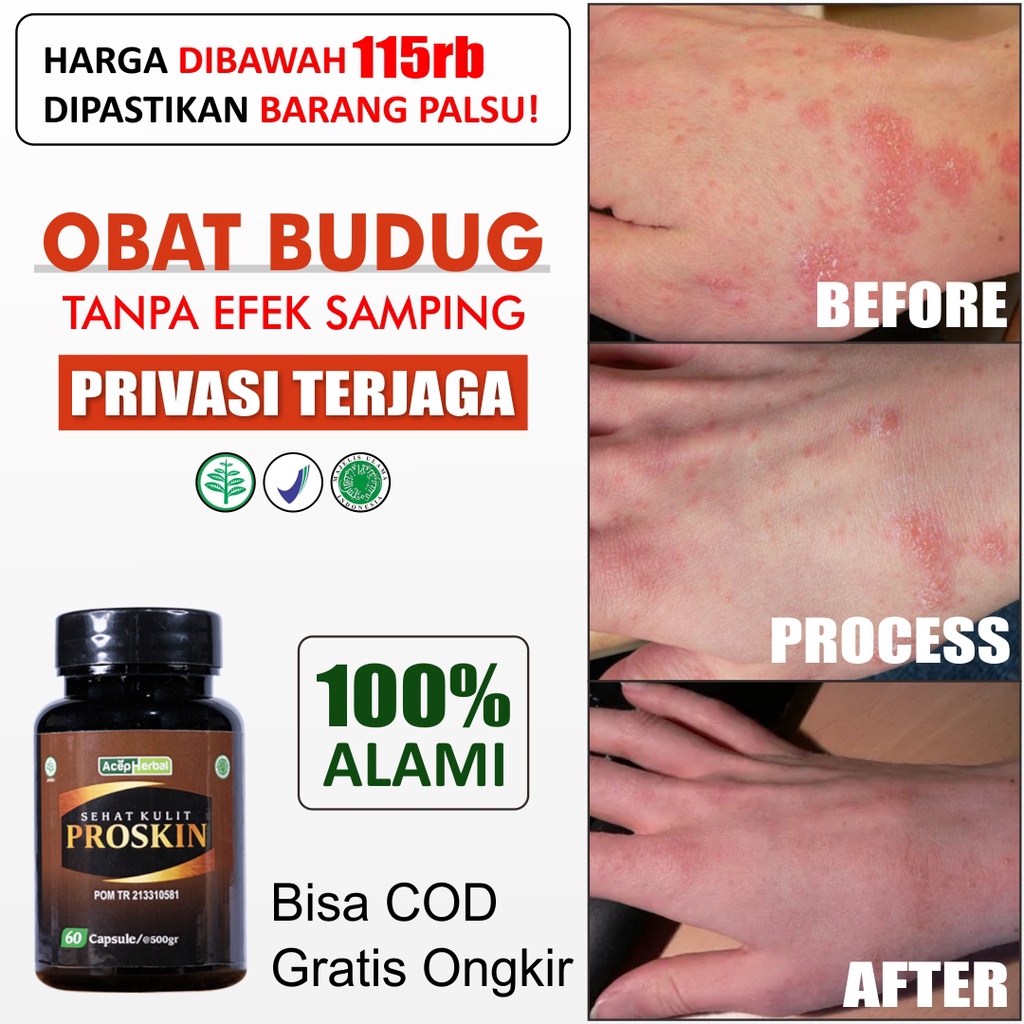 Jual Obat Budug Gatal Penghilang Koreng Borokan Scabies Manusia Gudik