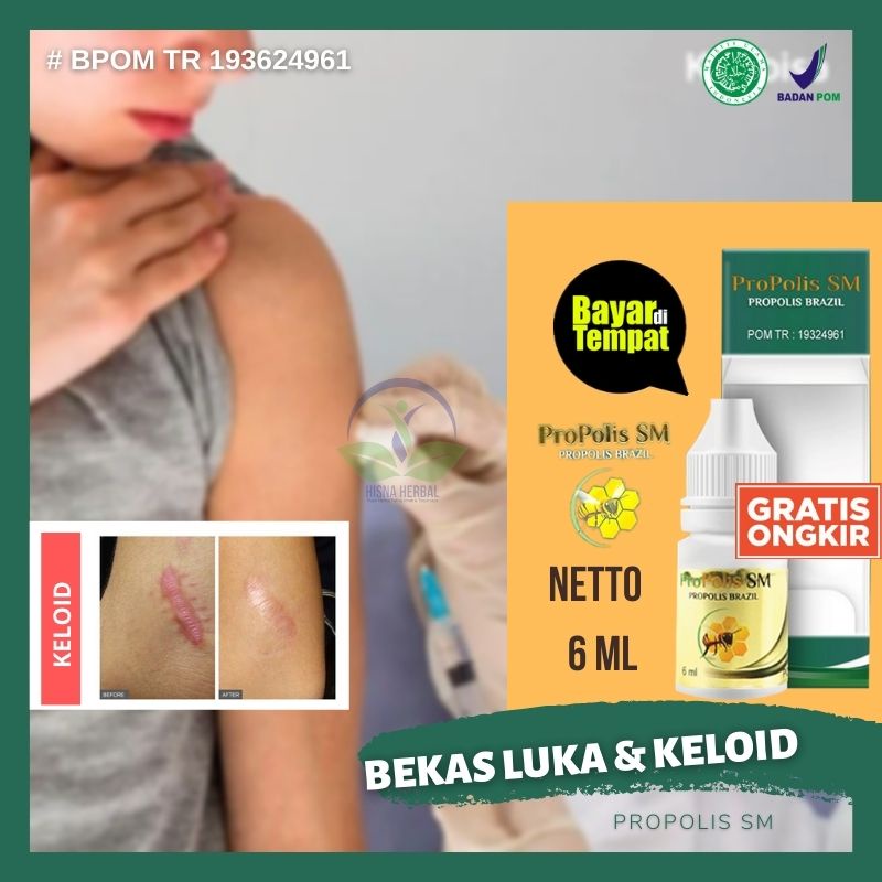 Jual Obat Pengempis Keloid Daging Jadi Tumbuh Pada Bekas Luka Salep