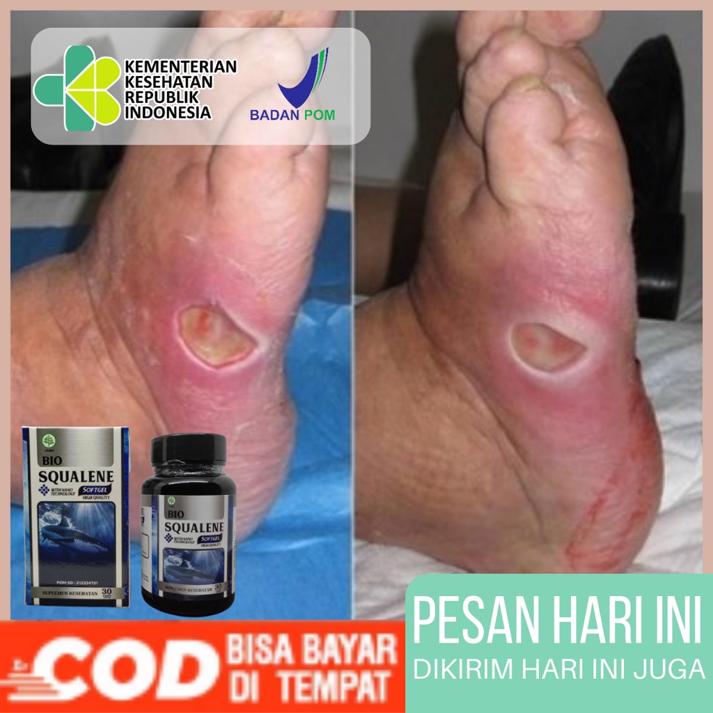 Jual Bio Squalene Softgel Obat Pengering Luka Diabetes Obat Luka