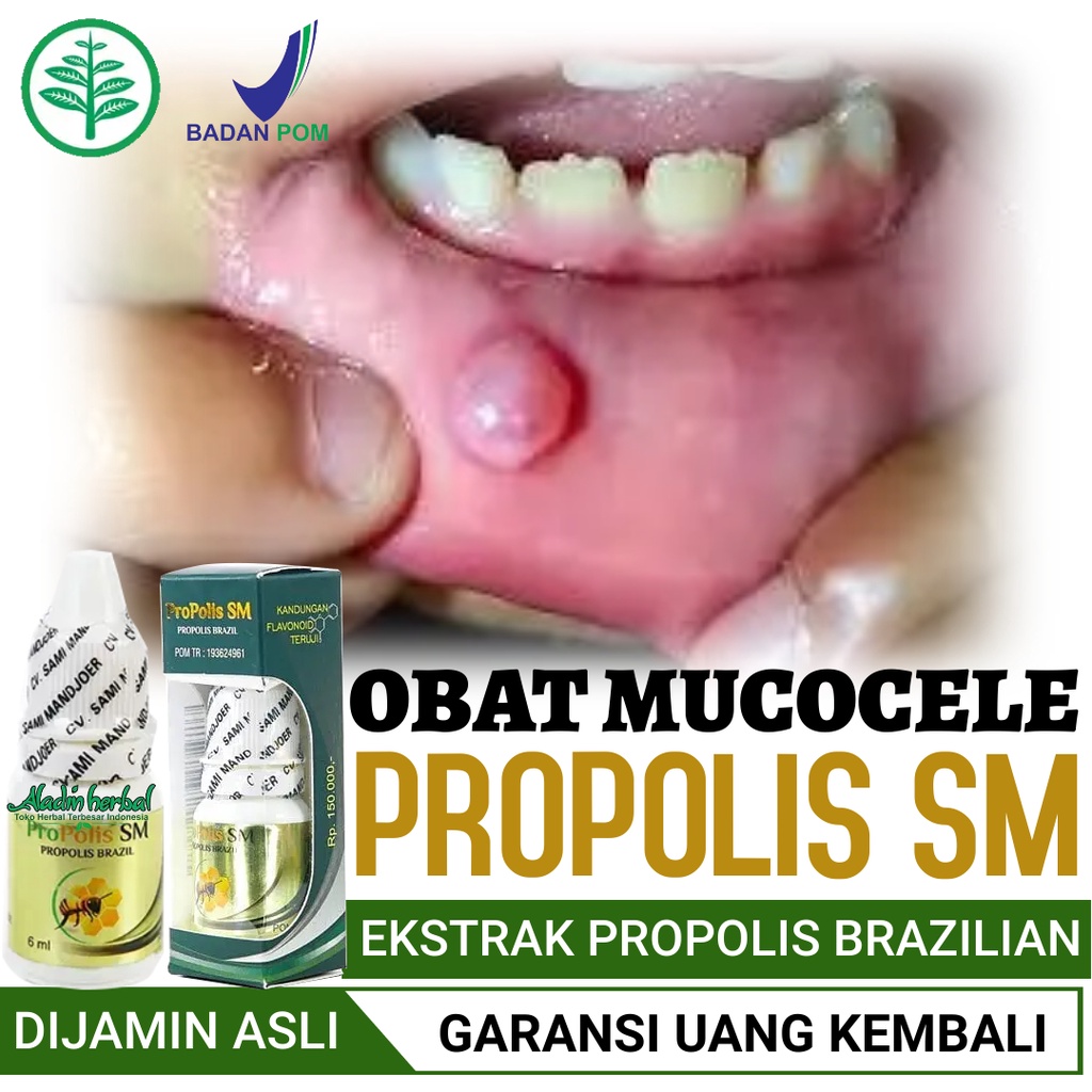 Jual Obat Mucocele Obat Benjolan Di Bibir Mulut Obat Sariawan Mulut