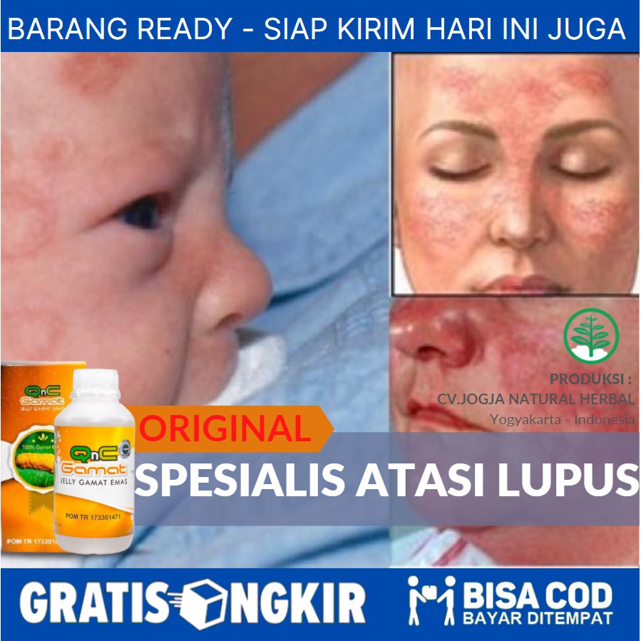 Jual Obat Herbal Untuk Penyakit Lupus Radang Pada Kulit Autoimun