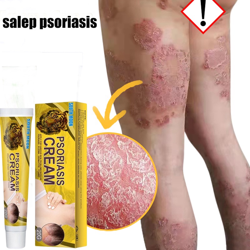 Jual Salep Psoriasis Krim Salep Gatal Salep Eksim Salep Kulit G Krim