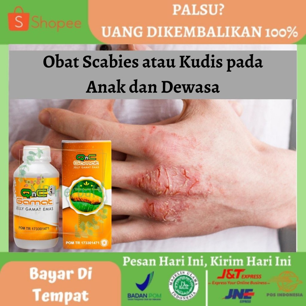 Jual Obat Scabies Obat Kudis Obat Kudis Gatal Obat Kulit Gatal Obat