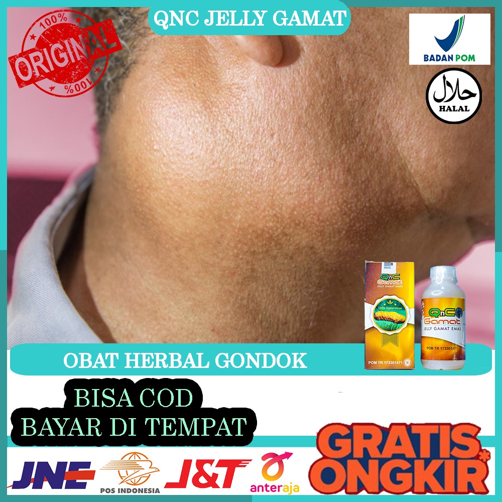 Jual Obat Herbal Gondok Kelenjar Tiroid Kelenjar Getah Bening Qnc