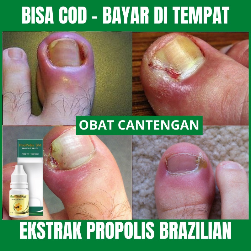 Jual Obat Cantengan Jempol Kaki Cantengan Kuku Cantengan Tangan