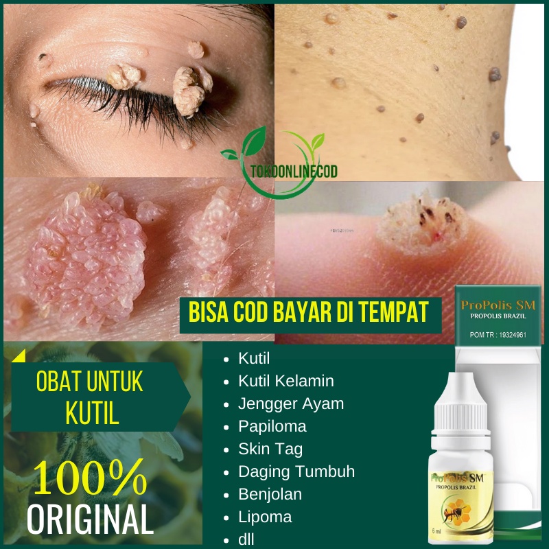 Jual Obat Perontok Kutil Papiloma Kutil Kelamin Skin Tag Di Leher