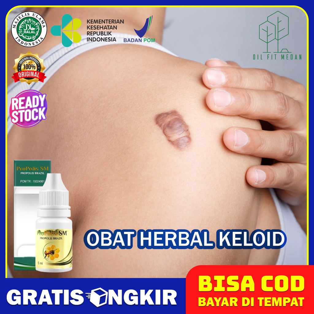 Jual Obat Herbal Keloid Daging Jadi Daging Tumbuh Penghilang