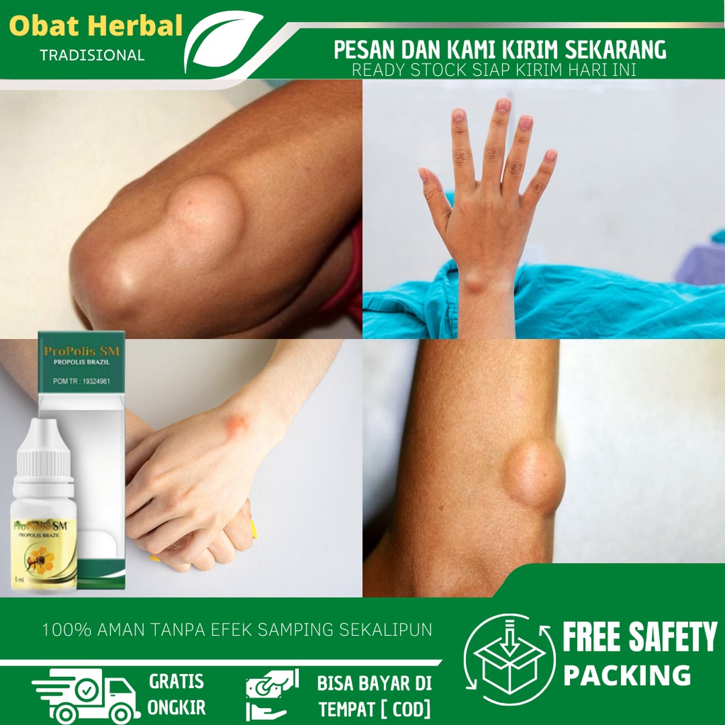 Jual Obat Penghancur Pengempis Benjolan Lipoma Uci Uci Tonjolan