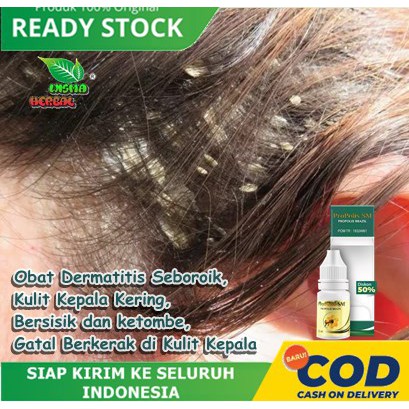 Jual Obat Dermatitis Seboroik Kulit Kepala Kering Bersisik Dan