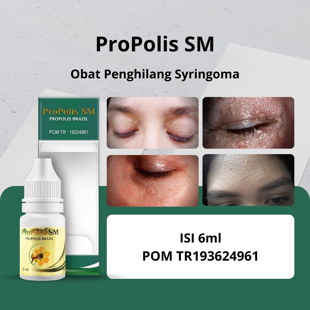 Jual Propolis SM Obat Penghilang Syringoma Milia Di Bawah Mata