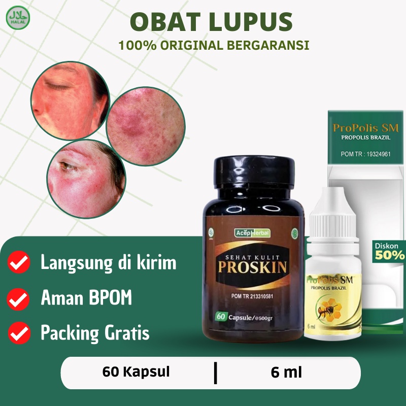 Jual Proskin Obat Penyakit Lupus Obat Ruam Kulit Di Wajah Obat