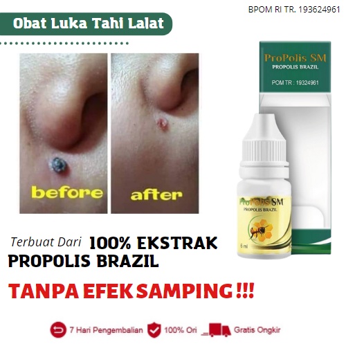 Jual Propolis SM Obat Penghilang Bekas Luka Tahi Lalat Terkelupas Dan