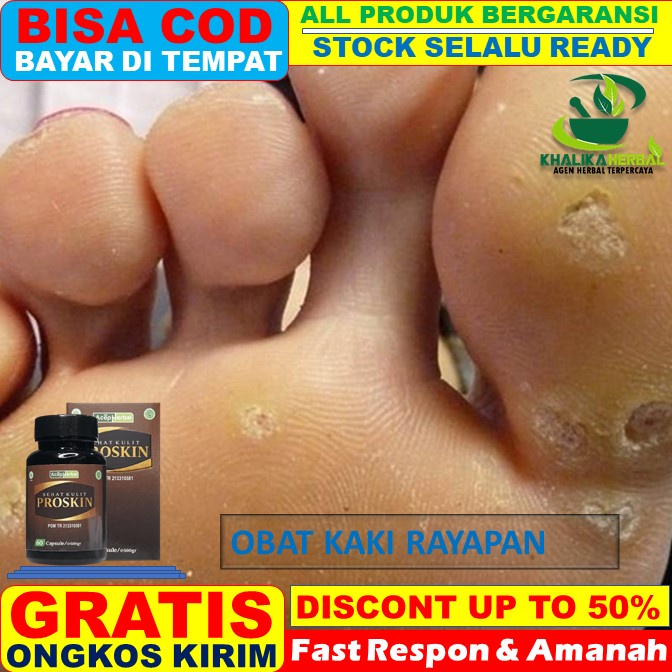 Jual Obat Kaki Rayapan Obat Kaki Rayapan Dan Bau Obat Kaki Rayapan Dan