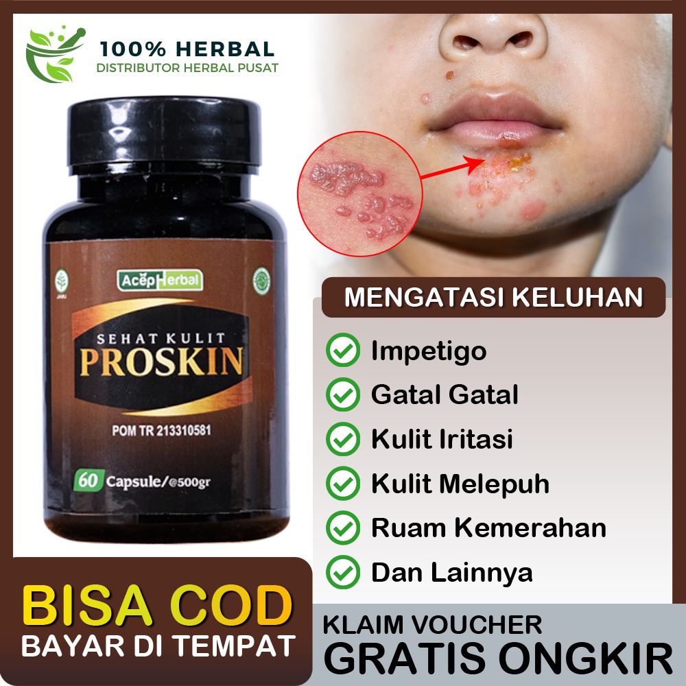 Jual Obat Herbal Impetigo Kulit Melepuh Gatal Berair Iritasi Ruam