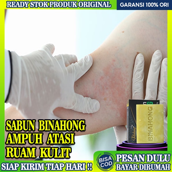 Jual Obat Gatal Ruam Merah Sabun Binahong Ruam Merah Di Tangan Obat