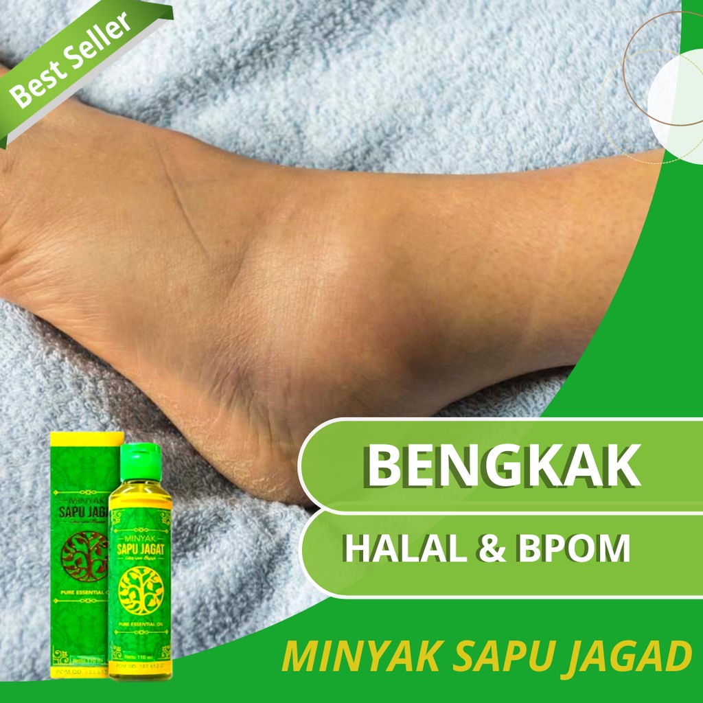 Jual Minyak Balur Untuk Kaki Bengkak Karena Jantung Ginjal Asam Urat