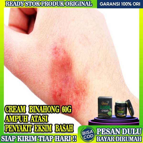 Jual Cream Obat Eksim Basah Tetulung Cream Binahong 60g Obat Eksim