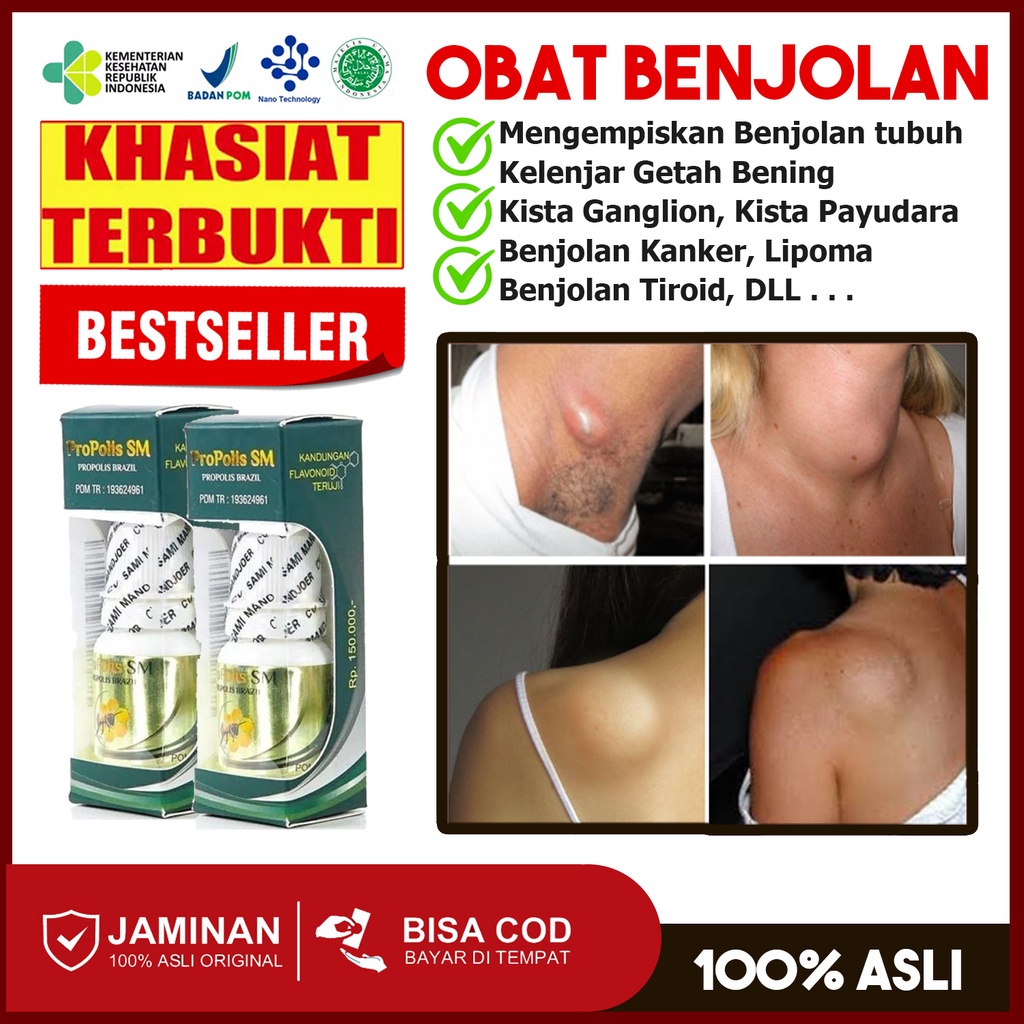 Jual Obat Pengempis Benjolan Di Ketiak Benjolan Leher Lipoma Benjolan