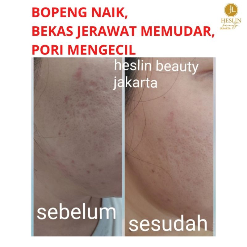 SERUM GLASS SKIN HESLIN BEAUTY FLEK, BEKAS JERAWAT, PORI-PORI (BPOM)